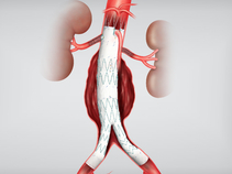 Zenith Fenestrated AAA in Anatomy
